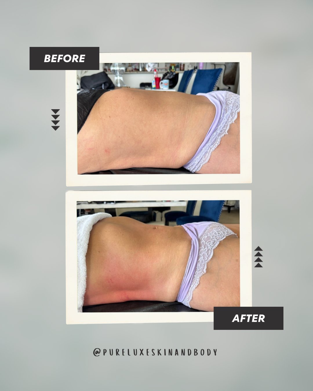 Before and after wood therapy body sculpting results