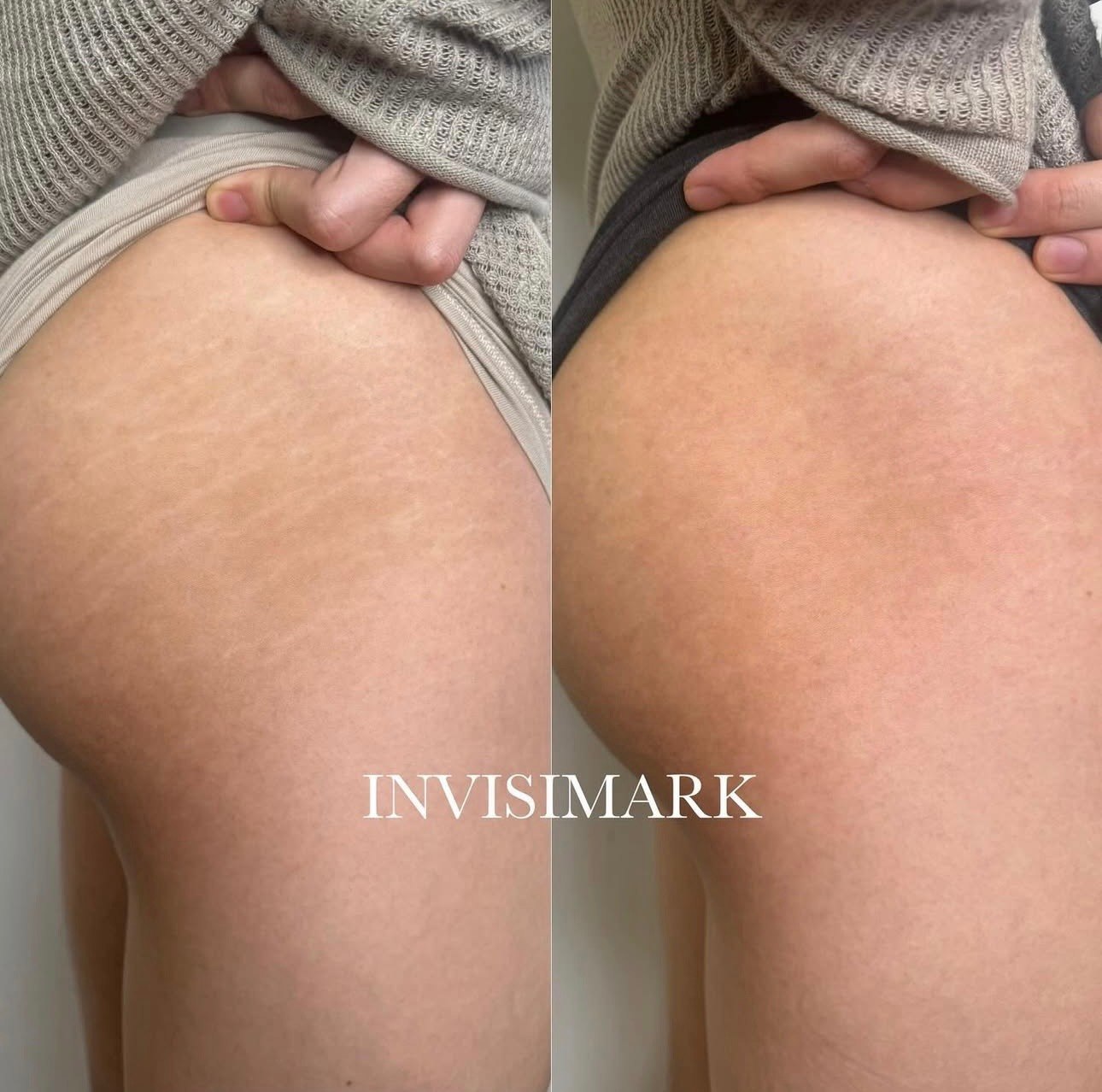 Stretch mark revision before and after